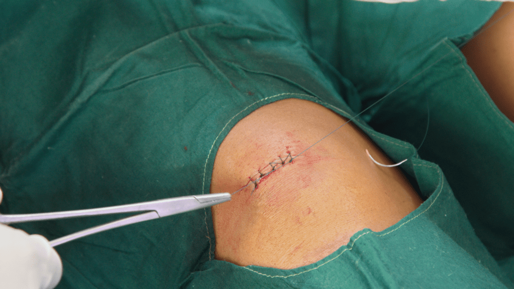sutura - um dos procedimentos médicos mais comuns